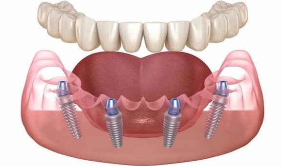 种植义齿修复有什么条件