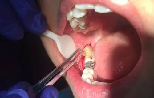 拔牙术中常见的并发症及防治