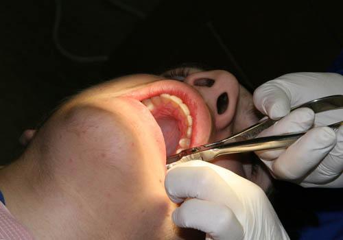 拔牙术后的并发症及防治