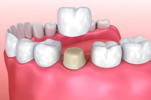镶牙前病人需接受哪些治疗