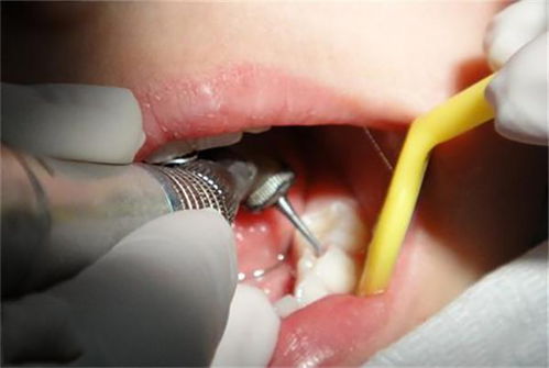 牙体预备会损伤牙髓吗