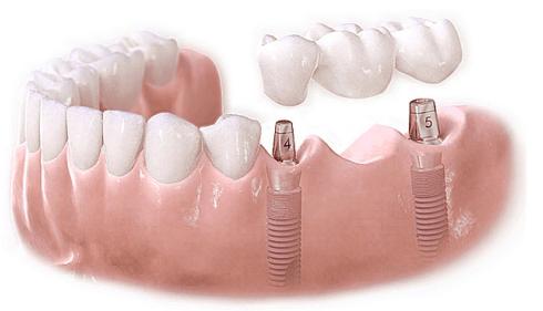 口腔种植材料应具备的性能