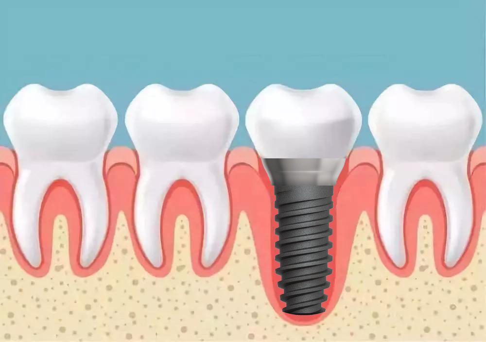 根状种植体分为哪几类