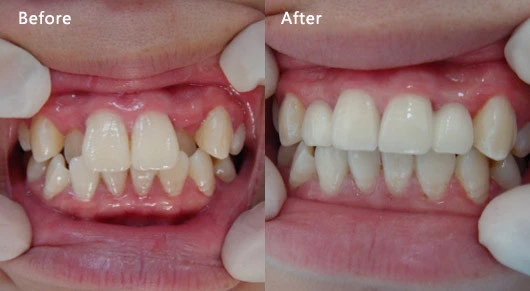 骨性错颌的矫治时机和矫治限度