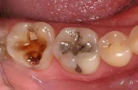 为什么说牙齿有龋应立即治疗