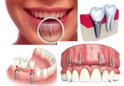 种植义齿成功的要素是什么