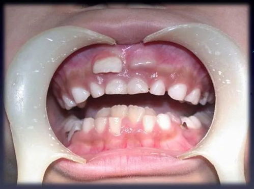影响牙齿萌出异常的常见因素是什么