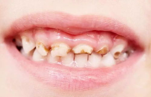 乳牙龋齿有哪些特点
