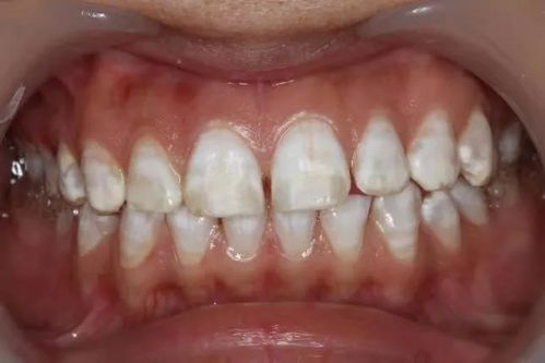 氟斑牙和四环素牙能治疗吗