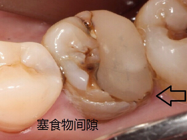 塞牙的常见原因是什么 如何治疗