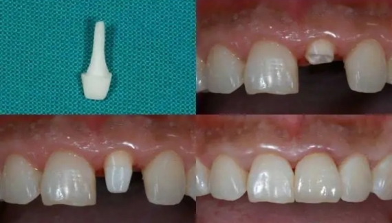 不拔掉牙根能镶牙吗