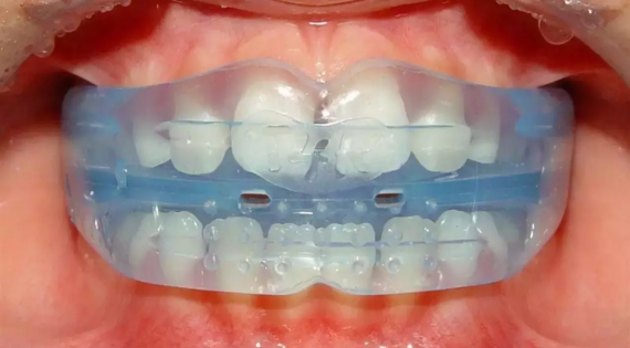 错颌畸形的预防有哪些