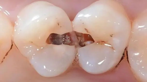 龋病的诊断要点及治疗原则