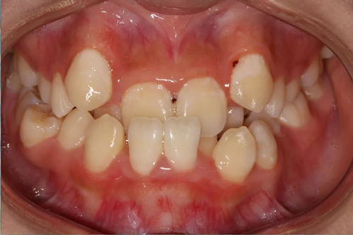 前牙反颌的临床表现及治疗原则