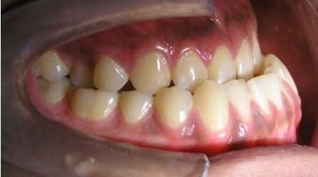 后牙反颌的临床表现及治疗原则