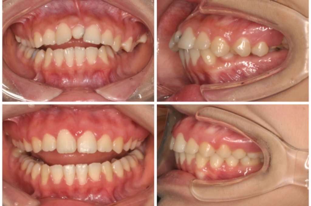 锁颌的临床表现及治疗原则