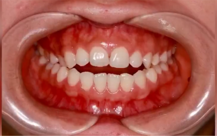 开颌的临床表现及治疗原则