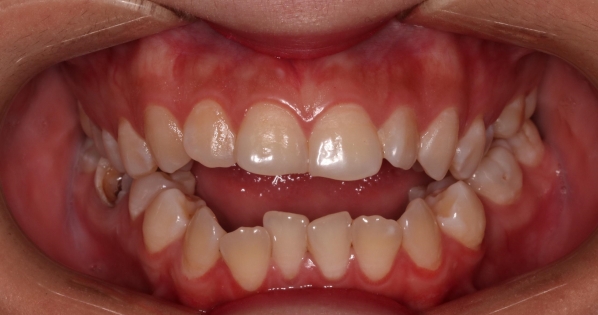 开颌的临床表现及治疗原则