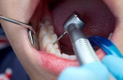 拔牙需要注意什么