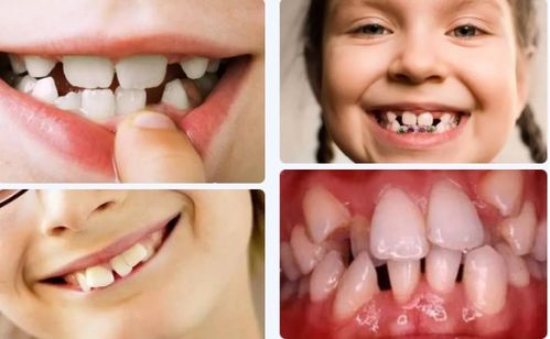 儿童错颌畸形有哪些危害