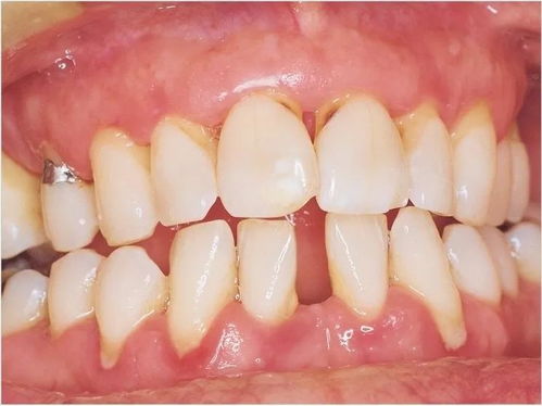 牙周病的定义及病因