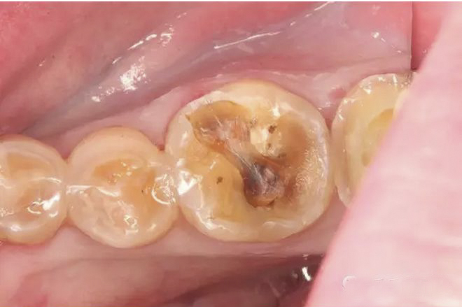 牙髓炎最常见哪些症状