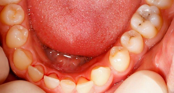 保护牙齿的六大误区有什么