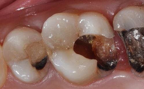 龋病应该何时就诊