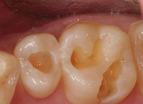 龋洞是如何充填的