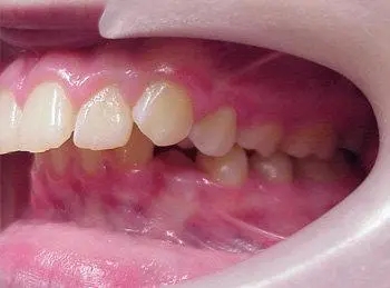 “暴牙齿”是怎样形成的