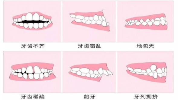 牙颌畸形会有哪些危害