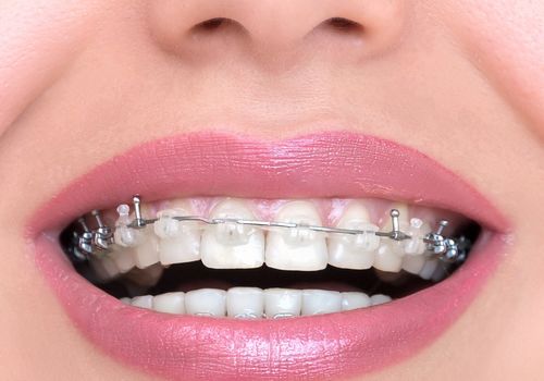 牙齿矫正的3种误区