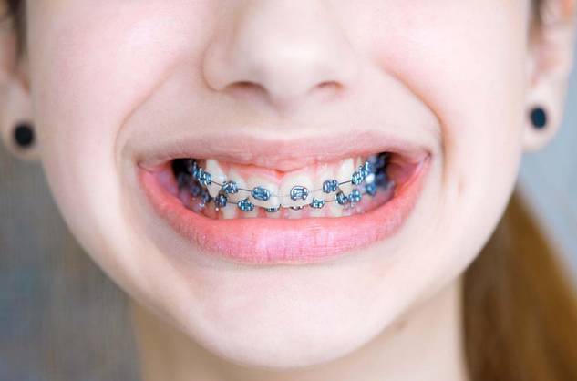 矫正牙齿应具备哪些条件