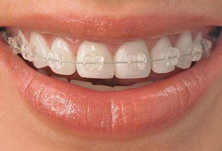 成人正畸治疗的目标