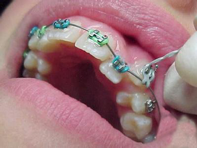 正畸治疗的牙齿移动是什么