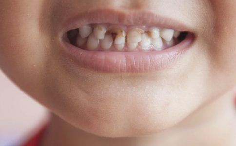 儿童龋齿的病因及预防