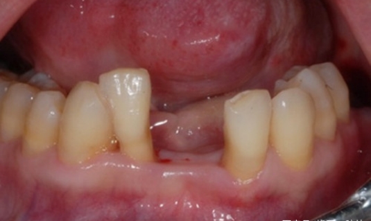 缺牙对咬合系统有什么影响