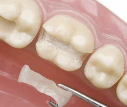 补牙材料充填时需要注意的六大问题