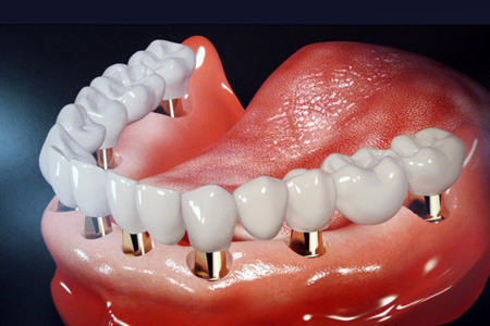 哪些牙缺失的患者适合做种植牙
