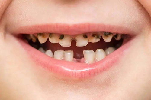 儿童牙齿缺失也应镶牙