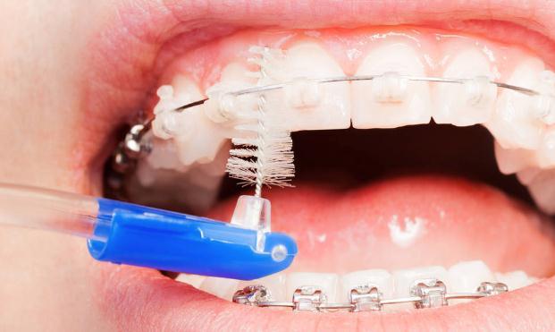 正畸期间刷牙技术要点是什么