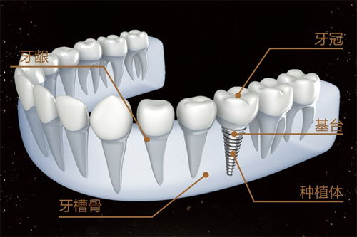 种植义齿的类型