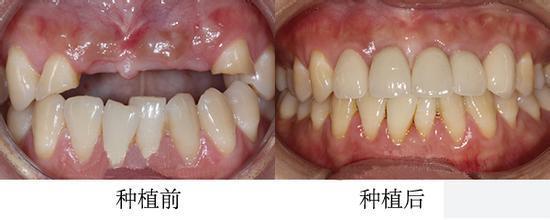 口腔种植义齿的优点