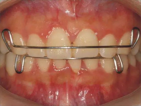错颌矫治后保持的种类