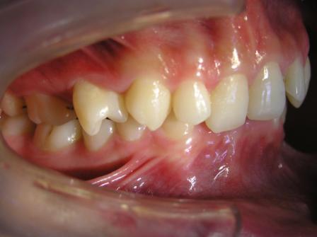 上颌前突早期矫治的方案