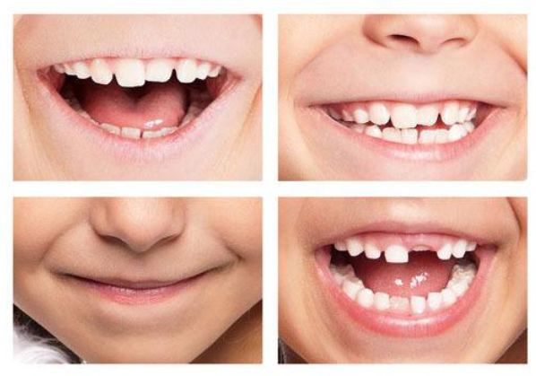 儿童换牙期间要注意哪些事项
