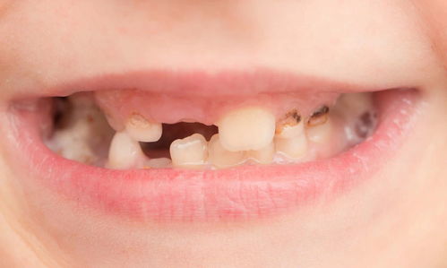 要如何保护儿童的乳恒牙替牙期
