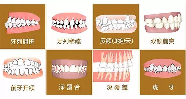 错颌畸形的矫治方法有哪些