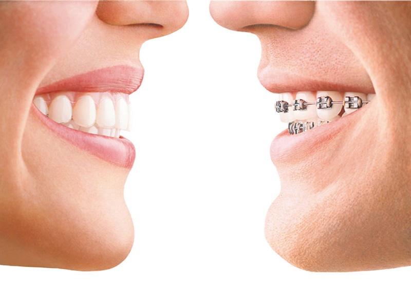 牙齿矫正过程中应注意什么