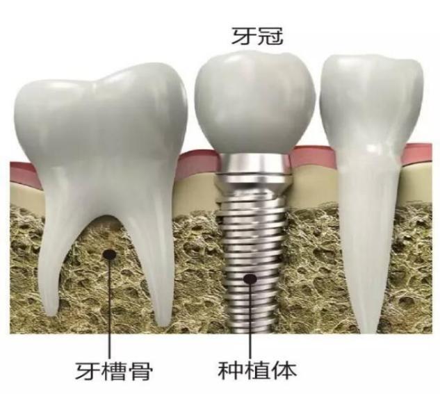 影响种植牙寿命长短的因素是什么